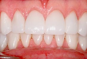 James C. Hazlett, DDS | Ceramic Crowns, Emergency Treatment and TMJ Disorders