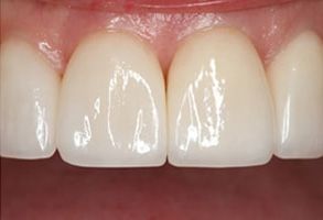 James C. Hazlett, DDS | Magnification and Illumination, Ceramic Crowns and Teeth Whitening