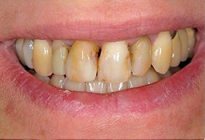James C. Hazlett, DDS | TMJ Disorders, Dental Fillings and Dentures
