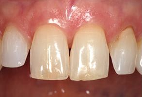 James C. Hazlett, DDS | Magnification and Illumination, Teeth Whitening and Ceramic Crowns